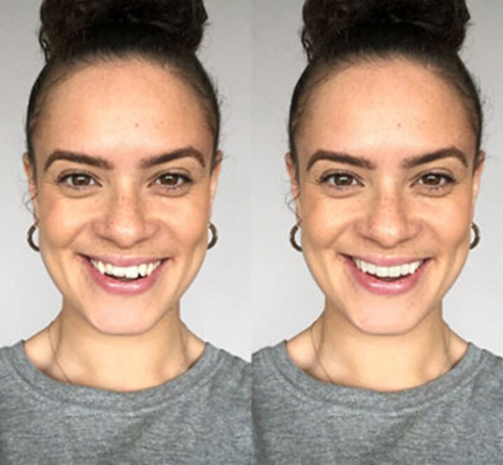 Invisalign Clear Aligners - Before and after image
