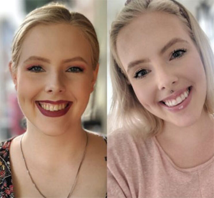 Invisalign Aligners - Before and after image