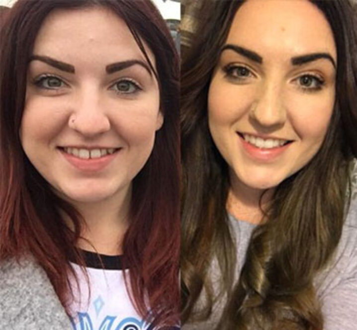 Invisalign - Before and after image