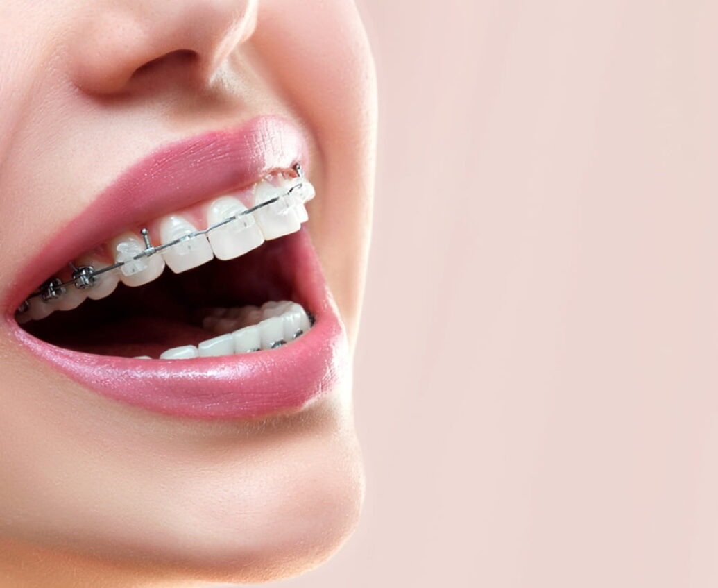 Traditional Wired Braces