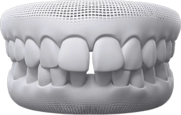 Treatment for Gaps between teeth