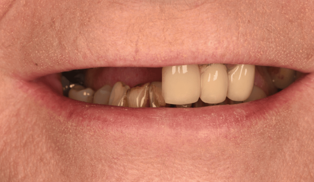 Before - Birmingham Dental Excellence