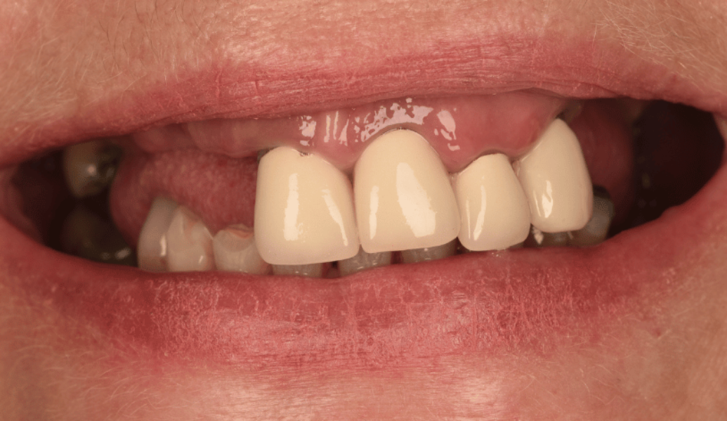 Before - Birmingham Dental Excellence