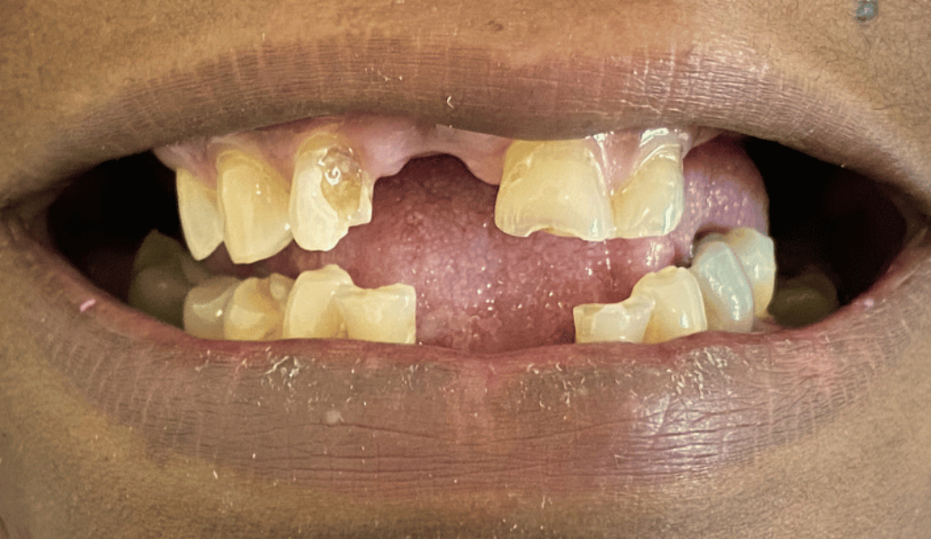 Before - Birmingham Dental Excellence