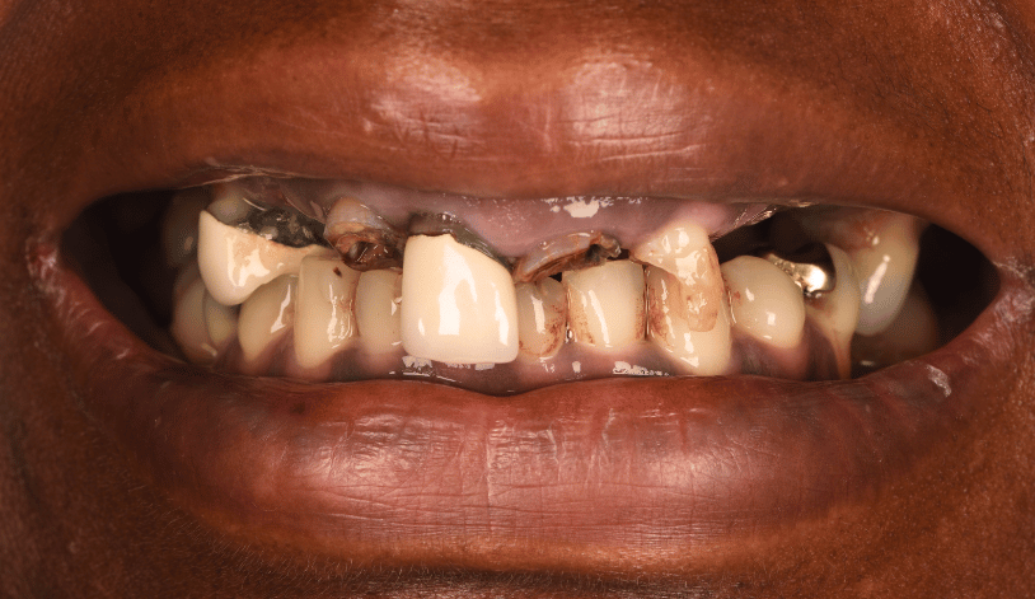 Before - Birmingham Dental Excellence