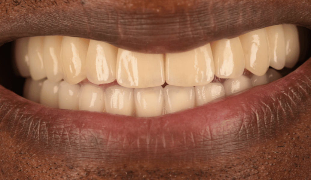 After - Birmingham Dental Excellence