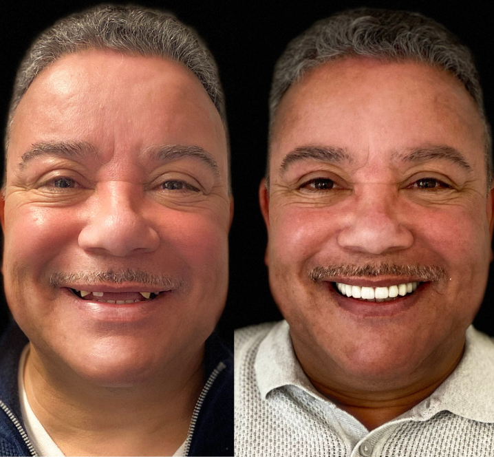 Invisalign Case - Before and After Photos