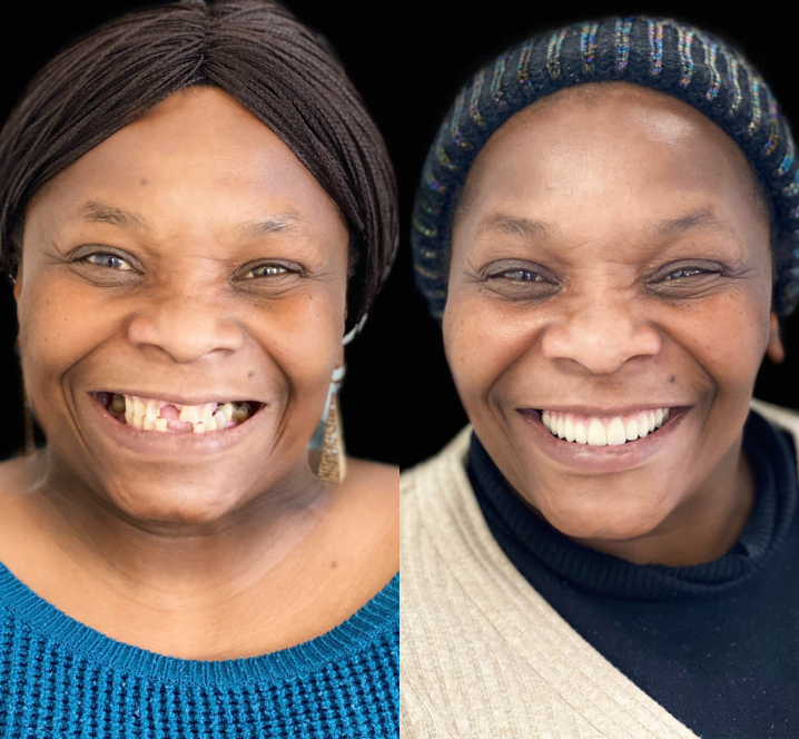 Invisalign Results - Before and After