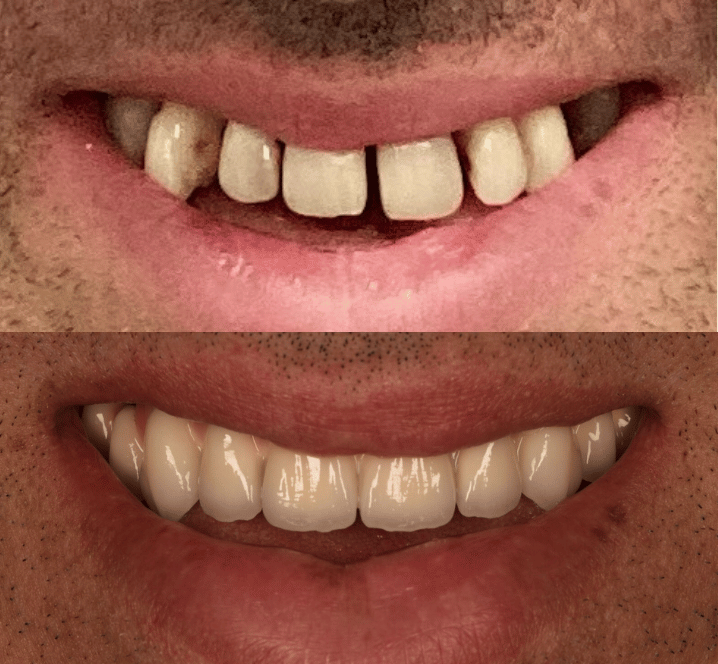 Invisalign Case - Before and After