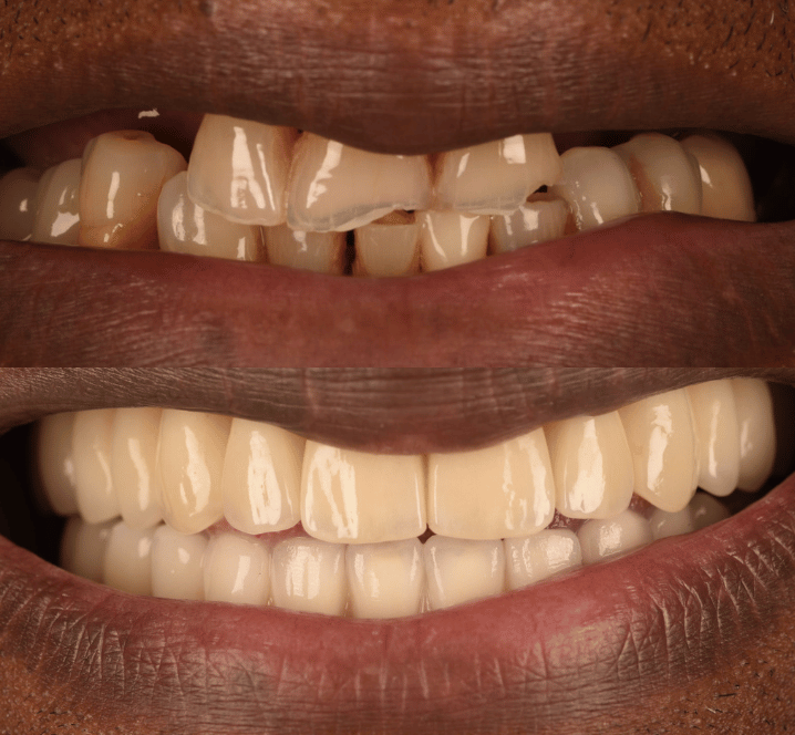 Invisalign Case - Before and After