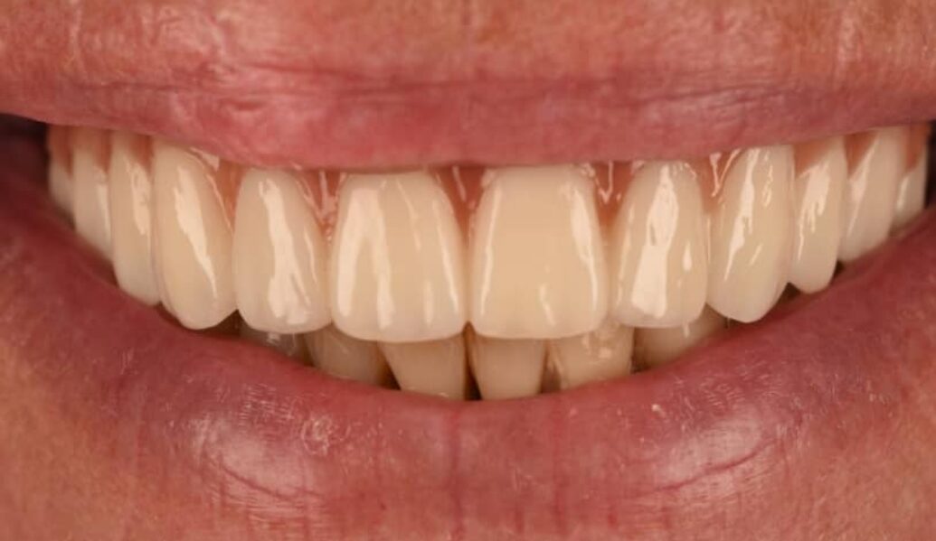 After - Birmingham Dental Excellence