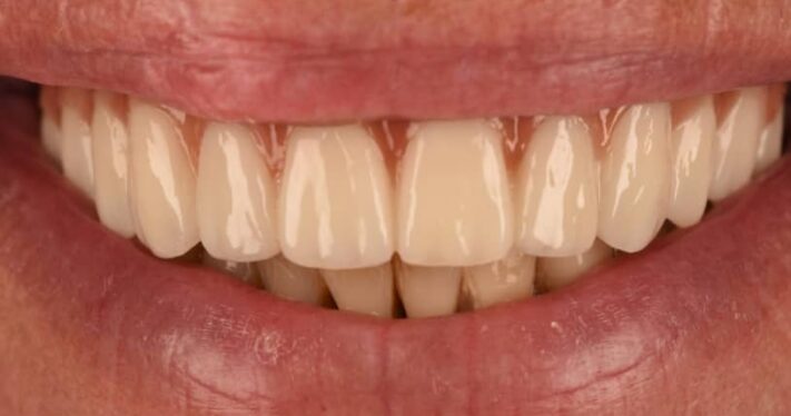 After - Birmingham Dental Excellence