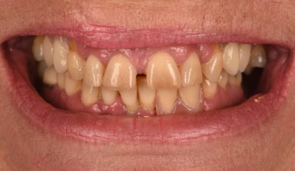 Before - Birmingham Dental Excellence
