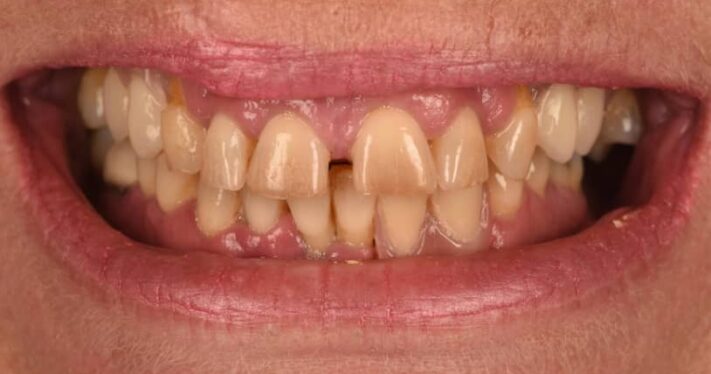 Before - Birmingham Dental Excellence