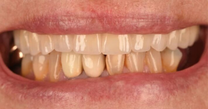 After - Birmingham Dental Excellence