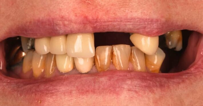 Before - Birmingham Dental Excellence