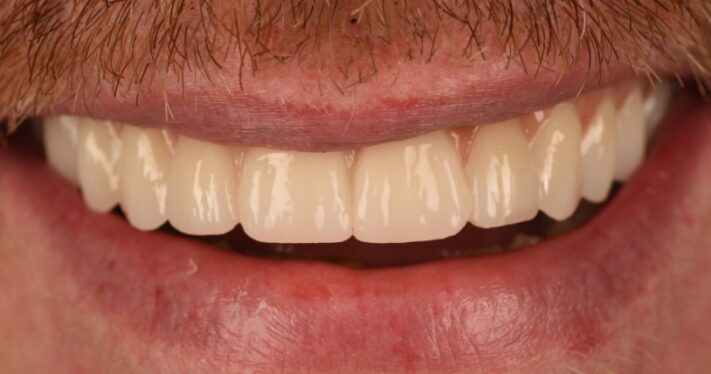 After - Birmingham Dental Excellence