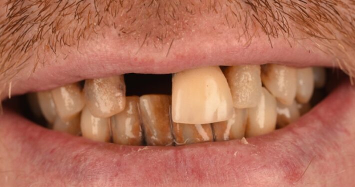 Before - Birmingham Dental Excellence