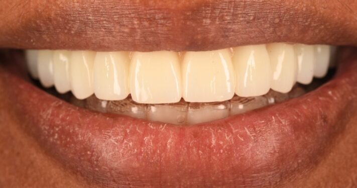 After - Birmingham Dental Excellence