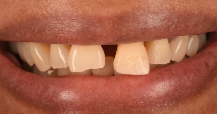 Before - Birmingham Dental Excellence