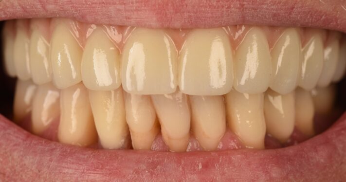 After - Birmingham Dental Excellence