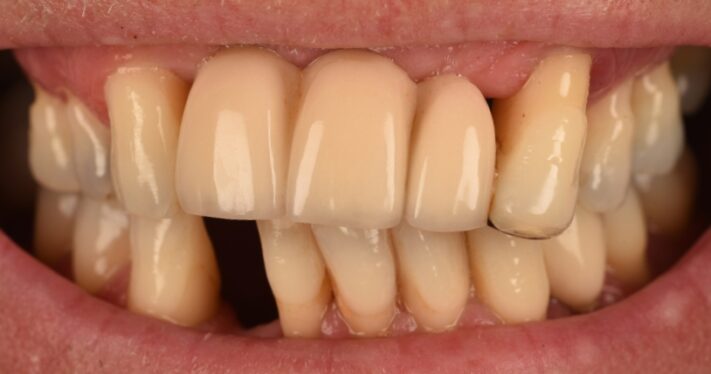 Before - Birmingham Dental Excellence