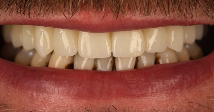 After - Birmingham Dental Excellence