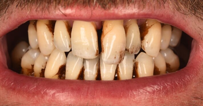 Before - Birmingham Dental Excellence