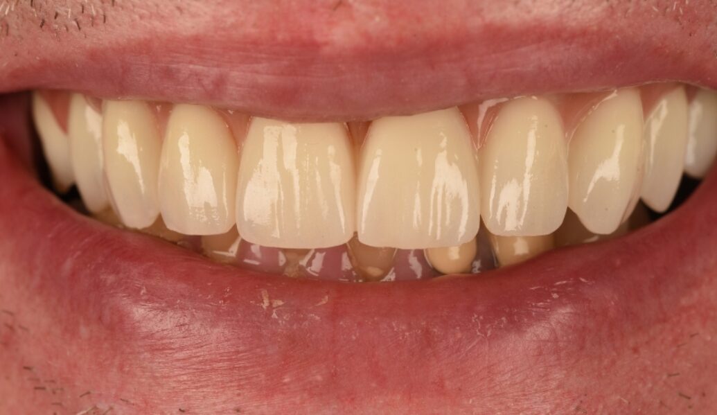 After - Birmingham Dental Excellence