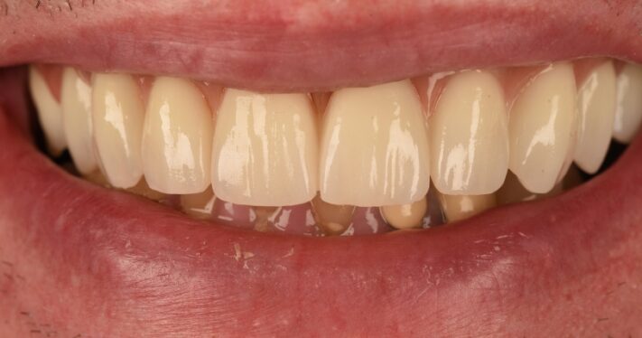 After - Birmingham Dental Excellence