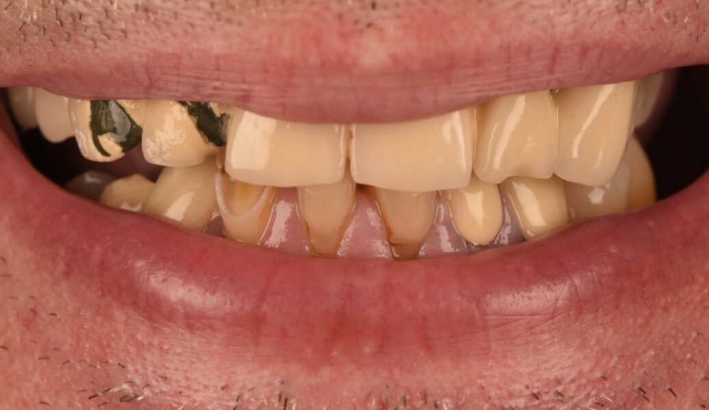 Before - Birmingham Dental Excellence