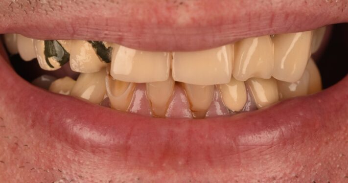 Before - Birmingham Dental Excellence