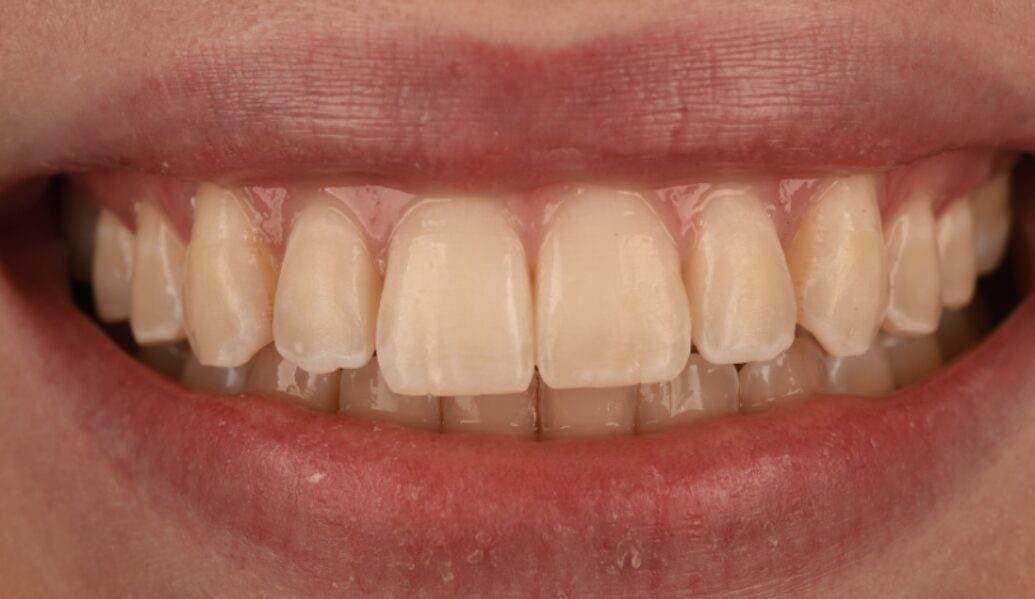 After - Birmingham Dental Excellence