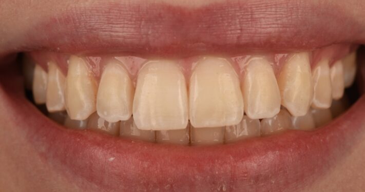 After - Birmingham Dental Excellence