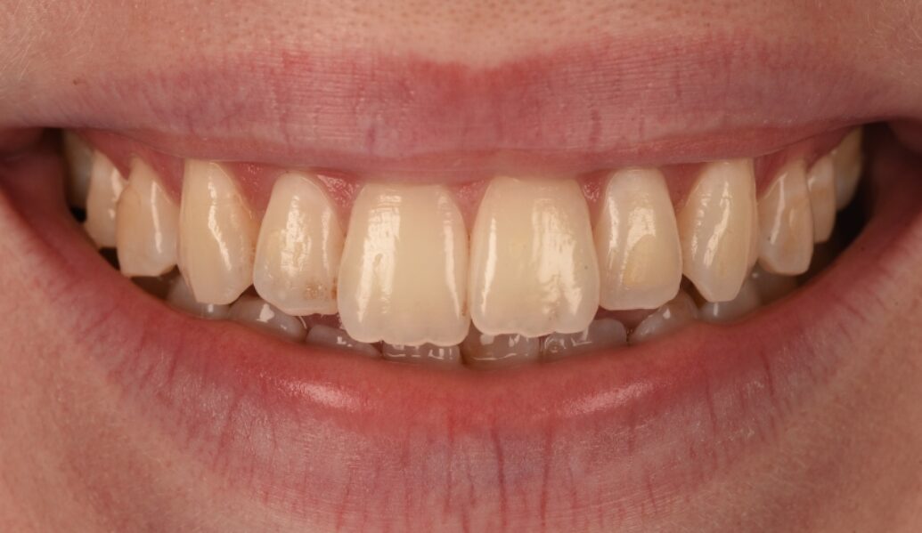 Before - Birmingham Dental Excellence