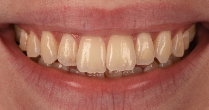 Before - Birmingham Dental Excellence