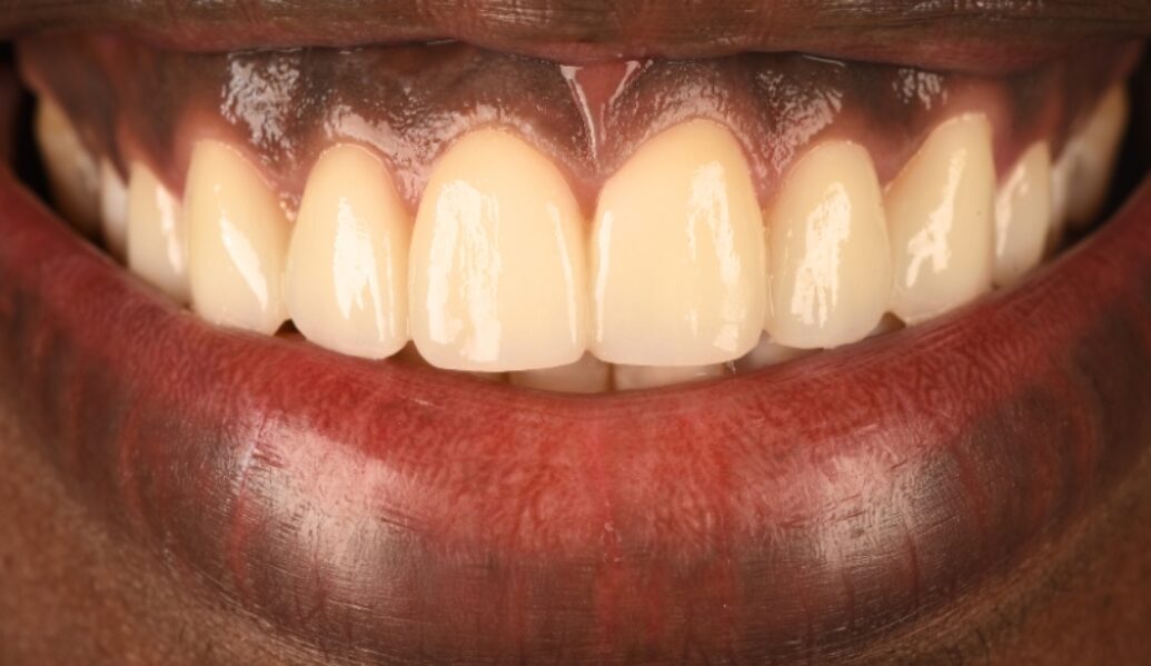 After - Birmingham Dental Excellence