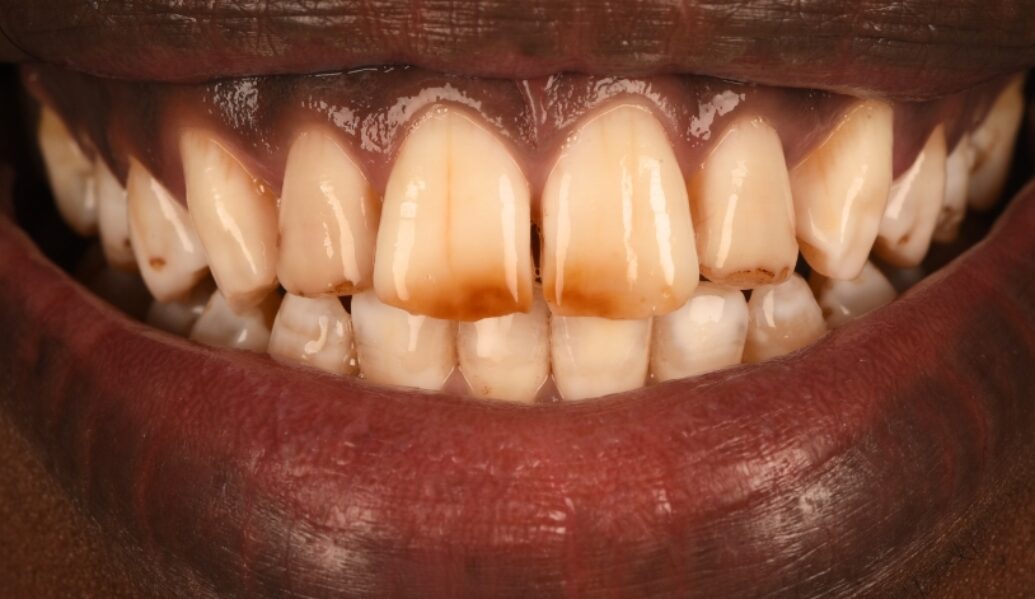 Before - Birmingham Dental Excellence
