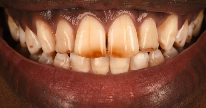 Before - Birmingham Dental Excellence