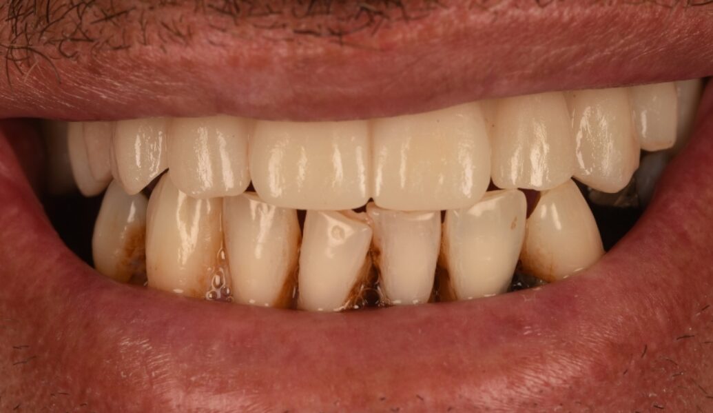 After - Birmingham Dental Excellence