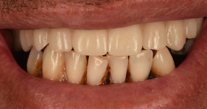 After - Birmingham Dental Excellence