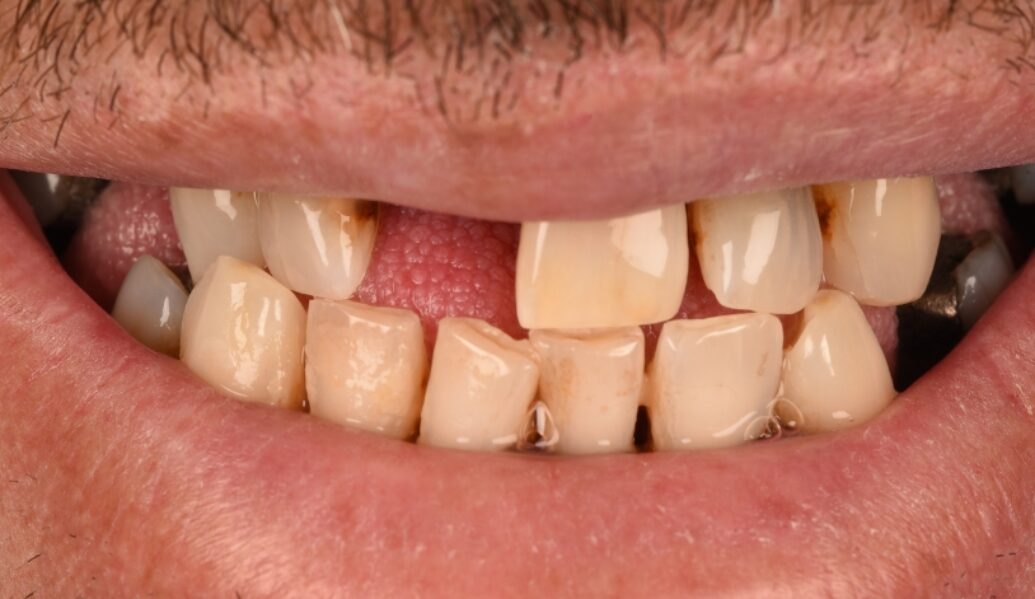 Before - Birmingham Dental Excellence