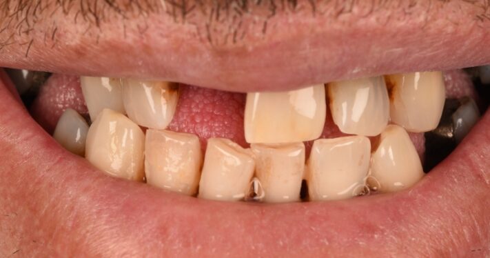 Before - Birmingham Dental Excellence