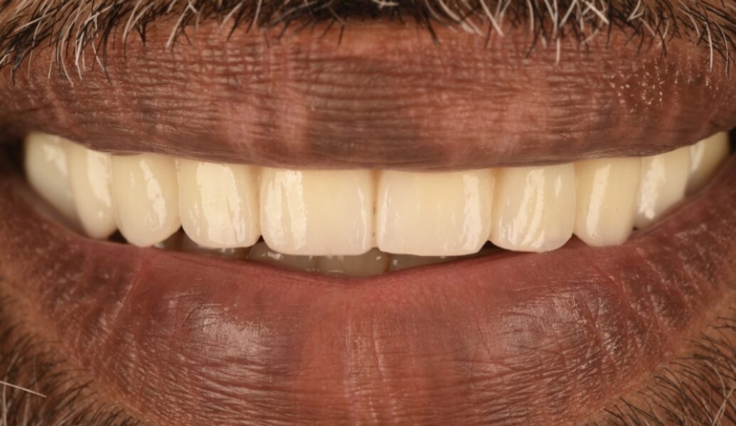 After - Birmingham Dental Excellence