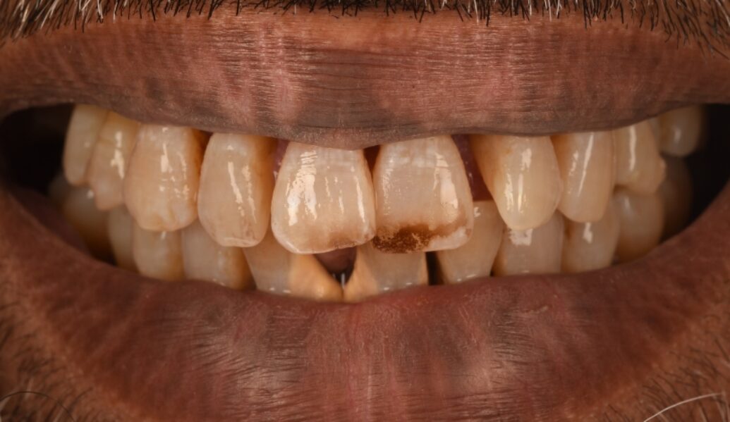 Before - Birmingham Dental Excellence
