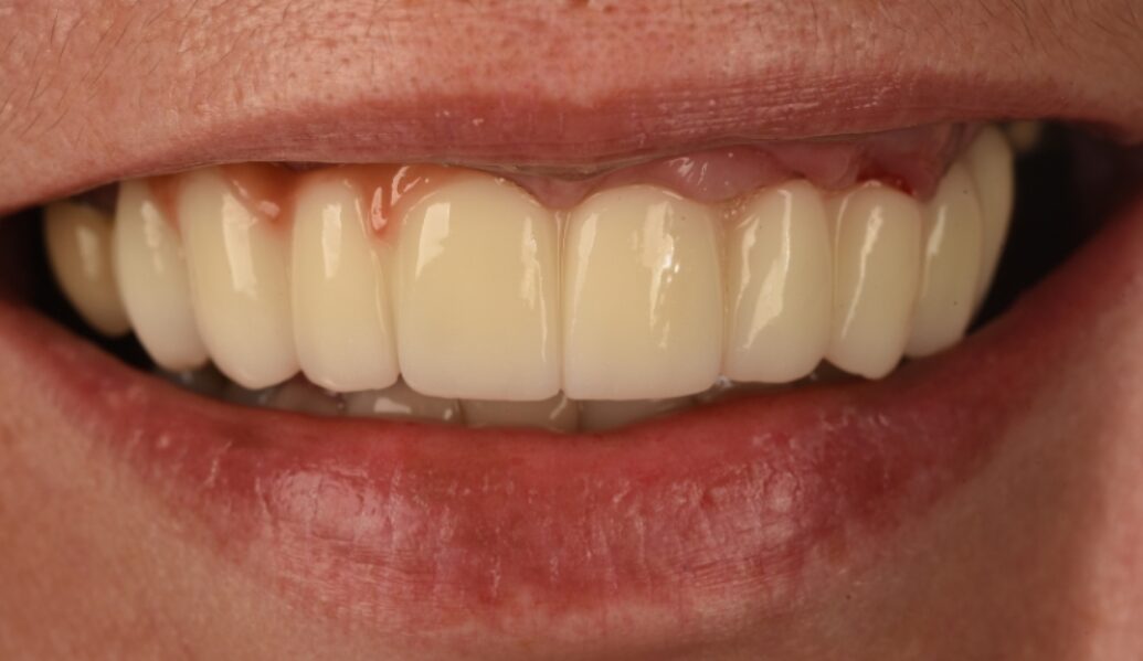 After - Birmingham Dental Excellence