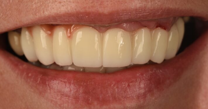 After - Birmingham Dental Excellence