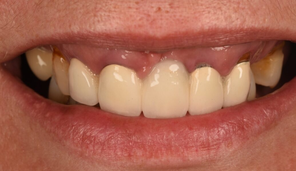 Before - Birmingham Dental Excellence