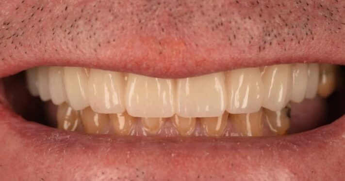 After - Birmingham Dental Excellence